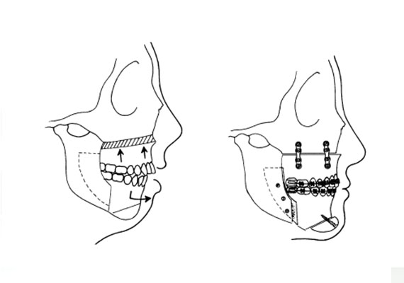 You might have noticed that your jaw is slanted, or perhaps a tad too sticking out. Perhaps your friends found difficulty in getting a decent frontal photograph of you. Maybe your teeth aren’t biting together in the way they should. Our specialists can help identify the issue, and offer viable and proven solutions to meet your exacting needs.