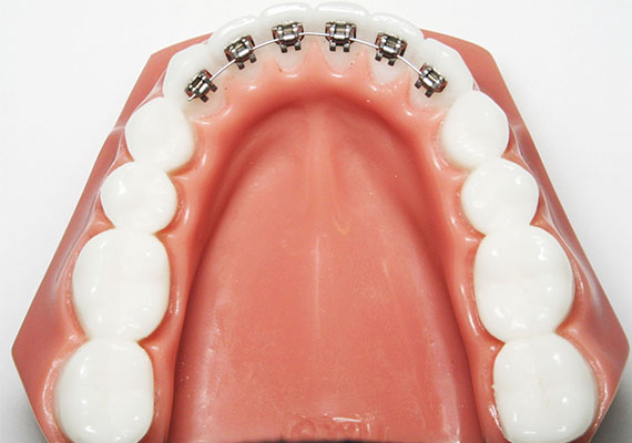 For patients who desire braces, but are unwilling or unable to have the conventional braces placed on the front-side of their teeth, we are also able to place special braces on the rear / tongue-facing side, thus making the braces treatment process less noticeable to the casual observer.