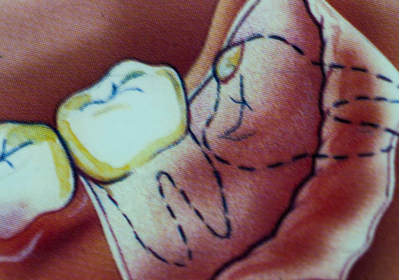 Often, the last teeth in the jaws can be problematic. Their inaccessibility make them hard to clean, causing infection and gum swellings, pain, bleeding, and jaw stiffness. Stagnation around them can also lead to decay and damage of the adjacent teeth. Sometimes, sacks of fluid (called cysts) may develop around them, leading to bone destruction and damage to the adjacent teeth.